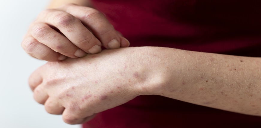 What is Psoriasis Disease? Its Causes, Symptoms, Diagnosis and Treatment