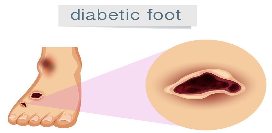 Diabetic Foot Ulcers - Causes, Symptoms, Stages, and Treatment