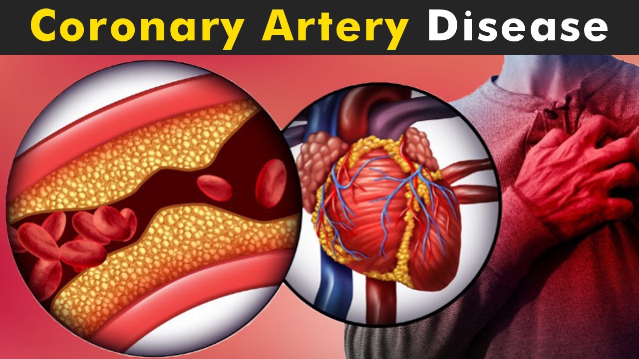 Coronary Artery Disease (CAD) - Causes, Symptoms, Treatment & Diagnosis | Max Lab