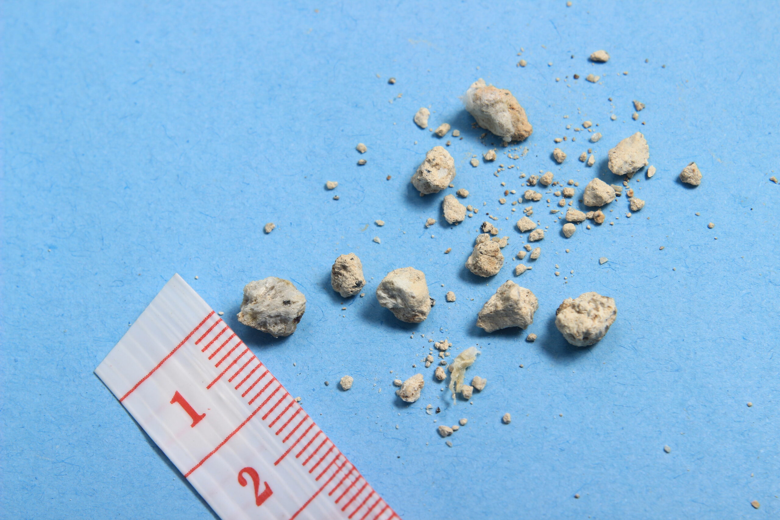 Kidney Stone Symptoms - Causes, Diagnosis & Treatment | Max Lab